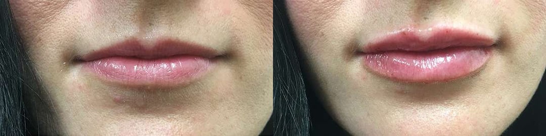 Injectable/Dermal Fillers Before And After Photos By Dr. Demetri Arnaoutakis In Tampa, Fl