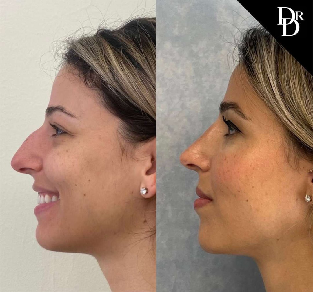 Rhinoplasty Before And After Photos By Dr. Demetri Arnaoutakis In Tampa, Fl