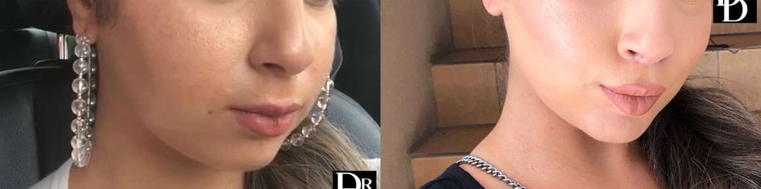 Buccal Fat Pad Removal Before And After Photos By Dr. Demetri Arnaoutakis In Tampa, Fl