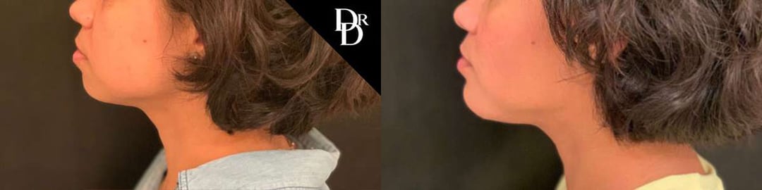 Chin Augmentation Before And After Photos By Dr. Demetri Arnaoutakis In Tampa, Fl