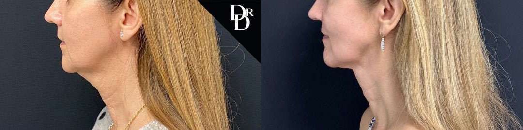 Facetite Before And After Photos By Dr. Demetri Arnaoutakis In Tampa, Fl