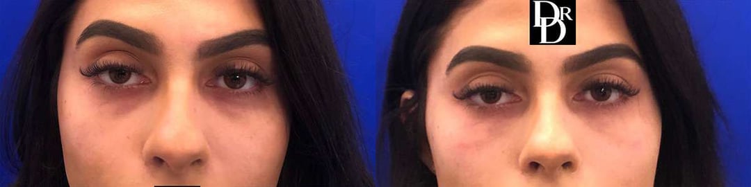 Injectable/Dermal Fillers Before And After Photos By Dr. Demetri Arnaoutakis In Tampa, Fl