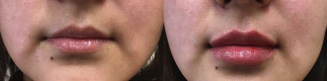 Injectable/Dermal Fillers Before And After Photos By Dr. Demetri Arnaoutakis In Tampa, Fl