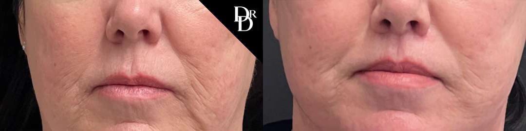 Lip Lift Before And After Photos By Dr. Demetri Arnaoutakis In Tampa, Fl
