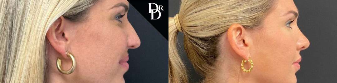 Rhinoplasty Before And After Photos By Dr. Demetri Arnaoutakis In Tampa, Fl