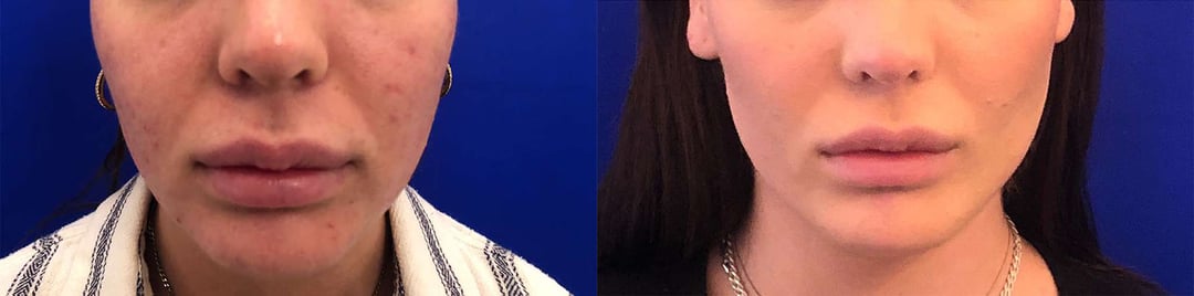 Buccal Fat Pad Removal Before And After Photos By Dr. Demetri Arnaoutakis In Tampa, Fl