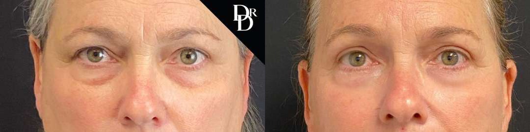 Eyelid Surgery Before And After Photos By Dr. Demetri Arnaoutakis In Tampa, Fl