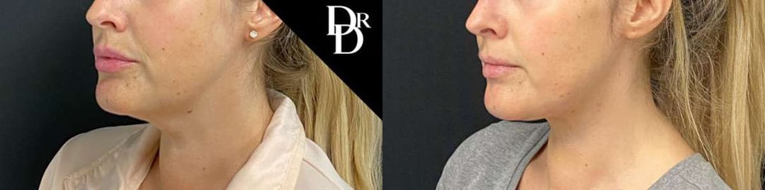 Facetite Before And After Photos By Dr. Demetri Arnaoutakis In Tampa, Fl