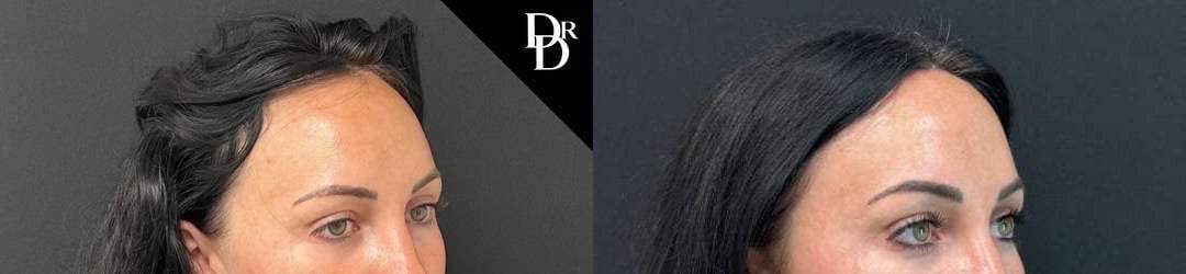 Hairline Lowering Surgery Before And After Photos By Dr. Demetri Arnaoutakis In Tampa, Fl