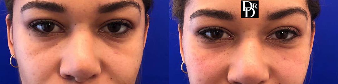 Injectable/Dermal Fillers Before And After Photos By Dr. Demetri Arnaoutakis In Tampa, Fl