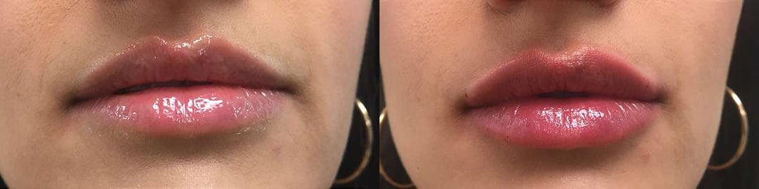 Injectable/Dermal Fillers Before And After Photos By Dr. Demetri Arnaoutakis In Tampa, Fl