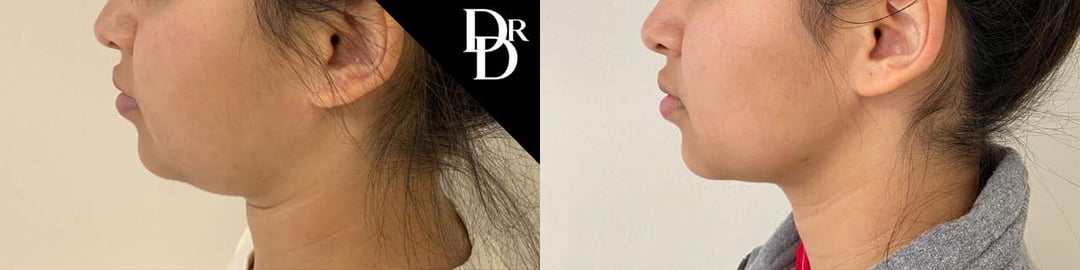 Neck Lift Before And After Photos By Dr. Demetri Arnaoutakis In Tampa, Fl