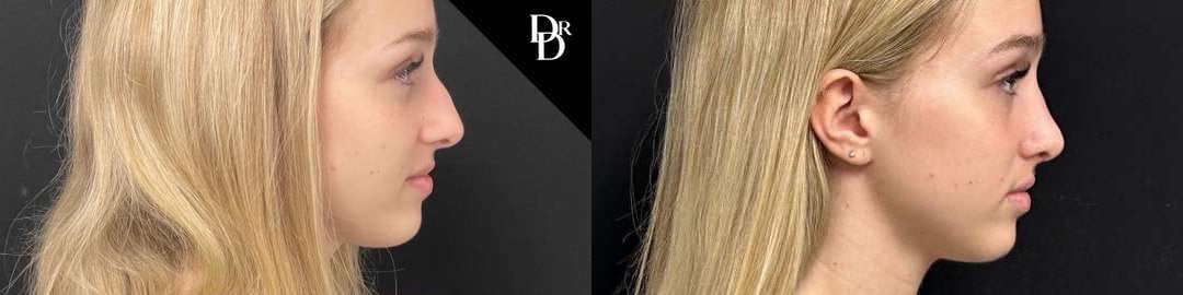 Rhinoplasty Before And After Photos By Dr. Demetri Arnaoutakis In Tampa, Fl