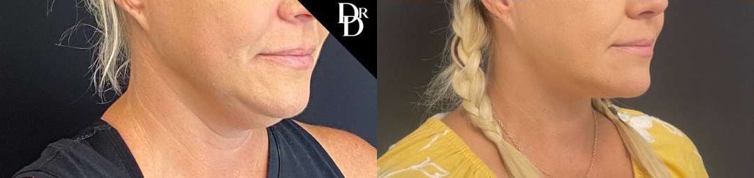 Facetite Before And After Photos By Dr. Demetri Arnaoutakis In Tampa, Fl