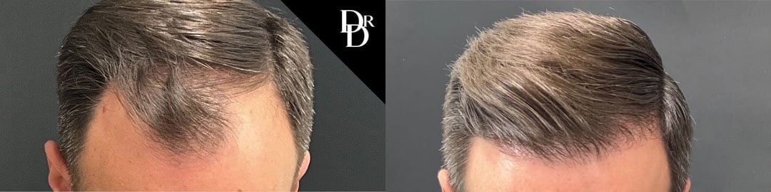 Hair Transplant Before And After Photos By Dr. Demetri Arnaoutakis In Tampa, Fl