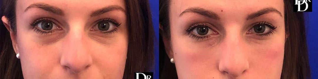 Injectable/Dermal Fillers Before And After Photos By Dr. Demetri Arnaoutakis In Tampa, Fl