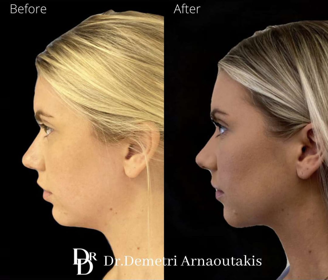 Neck Lift Before And After Photos By Dr. Demetri Arnaoutakis In Tampa, Fl