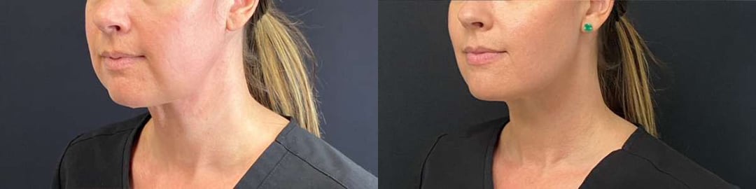 Facetite Before And After Photos By Dr. Demetri Arnaoutakis In Tampa, Fl