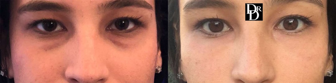 Injectable/Dermal Fillers Before And After Photos By Dr. Demetri Arnaoutakis In Tampa, Fl