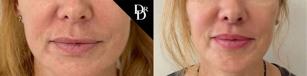 Lip Lift Before And After Photos By Dr. Demetri Arnaoutakis In Tampa, Fl