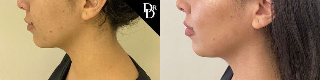 Morpheus8 Before And After Photos By Dr. Demetri Arnaoutakis In Tampa, Fl