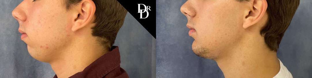 Chin Augmentation Before And After Photos By Dr. Demetri Arnaoutakis In Tampa, Fl
