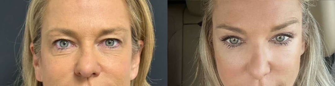 Eyelid Surgery Before And After Photos By Dr. Demetri Arnaoutakis In Tampa, Fl