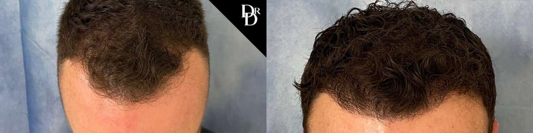 Hair Transplant Before And After Photos By Dr. Demetri Arnaoutakis In Tampa, Fl
