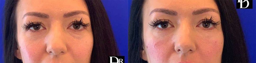 Injectable/Dermal Fillers Before And After Photos By Dr. Demetri Arnaoutakis In Tampa, Fl