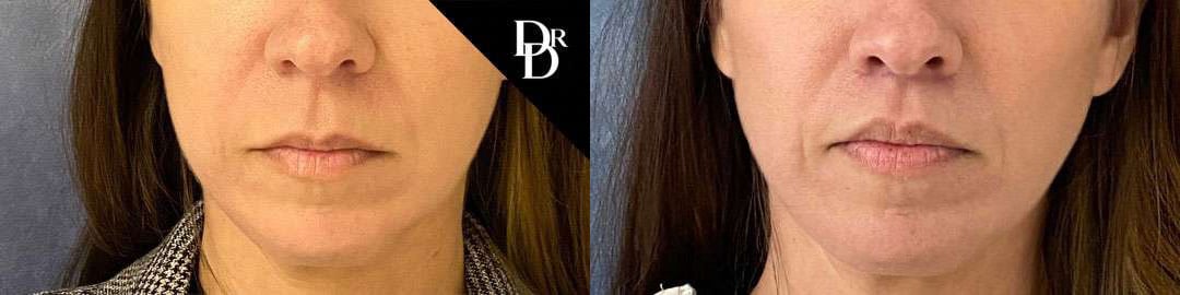 Lip Lift Before And After Photos By Dr. Demetri Arnaoutakis In Tampa, Fl