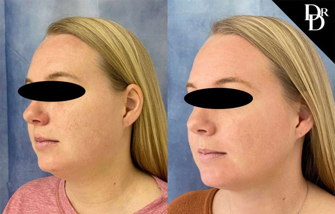 Neck Lift Before And After Photos By Dr. Demetri Arnaoutakis In Tampa, Fl