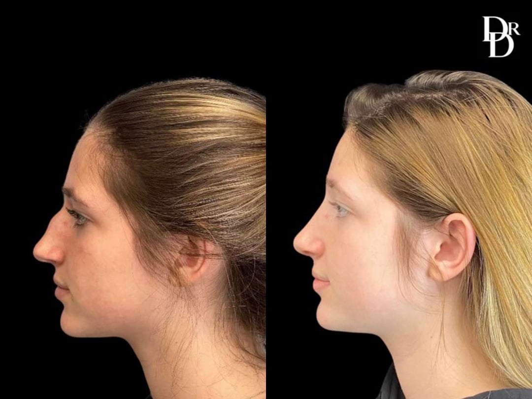 Rhinoplasty Before And After Photos By Dr. Demetri Arnaoutakis In Tampa, Fl