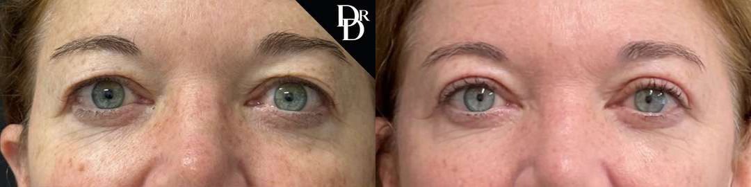 Eyelid Surgery Before And After Photos By Dr. Demetri Arnaoutakis In Tampa, Fl