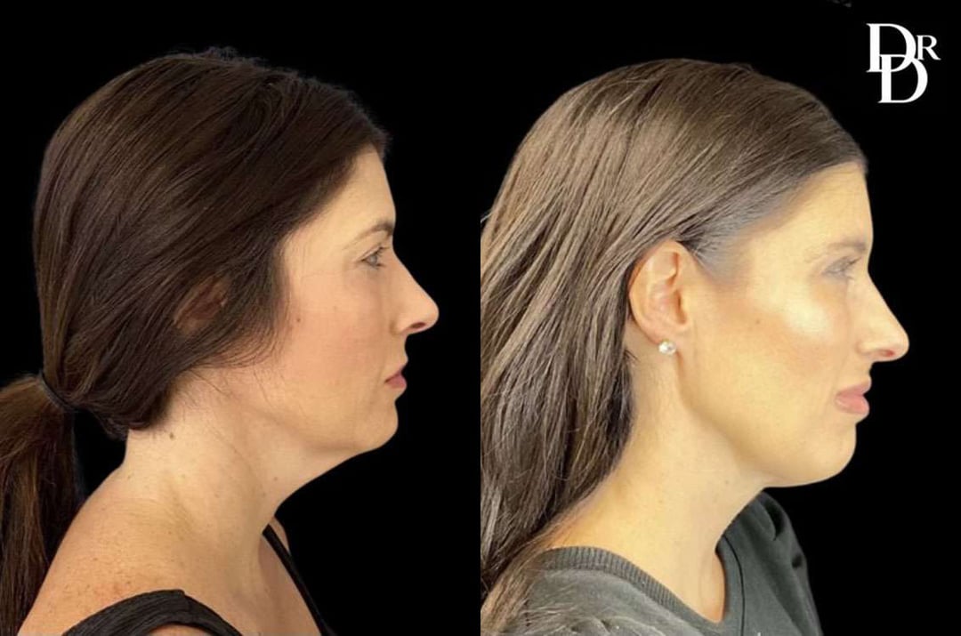 Facetite Before And After Photos By Dr. Demetri Arnaoutakis In Tampa, Fl
