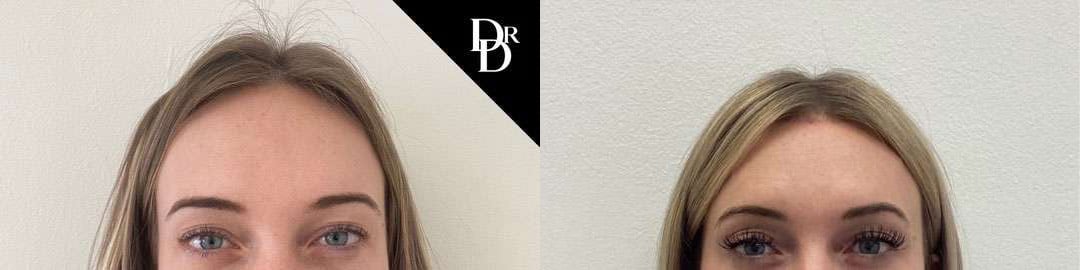 Hairline Lowering Surgery Before And After Photos By Dr. Demetri Arnaoutakis In Tampa, Fl