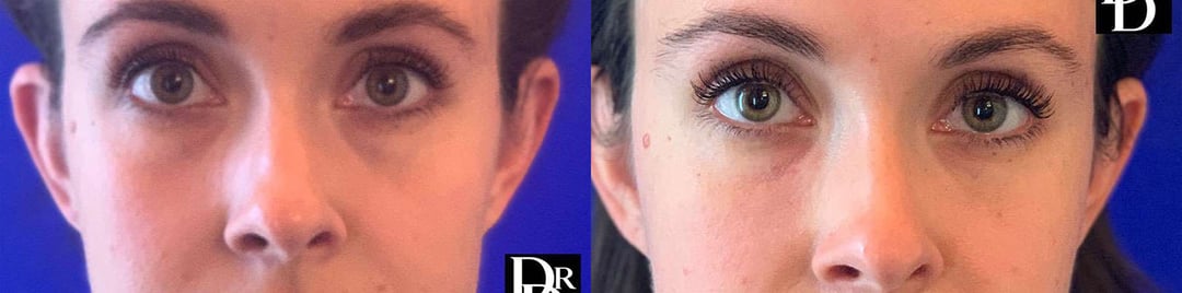 Injectable/Dermal Fillers Before And After Photos By Dr. Demetri Arnaoutakis In Tampa, Fl