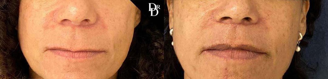 Lip Lift Before And After Photos By Dr. Demetri Arnaoutakis In Tampa, Fl