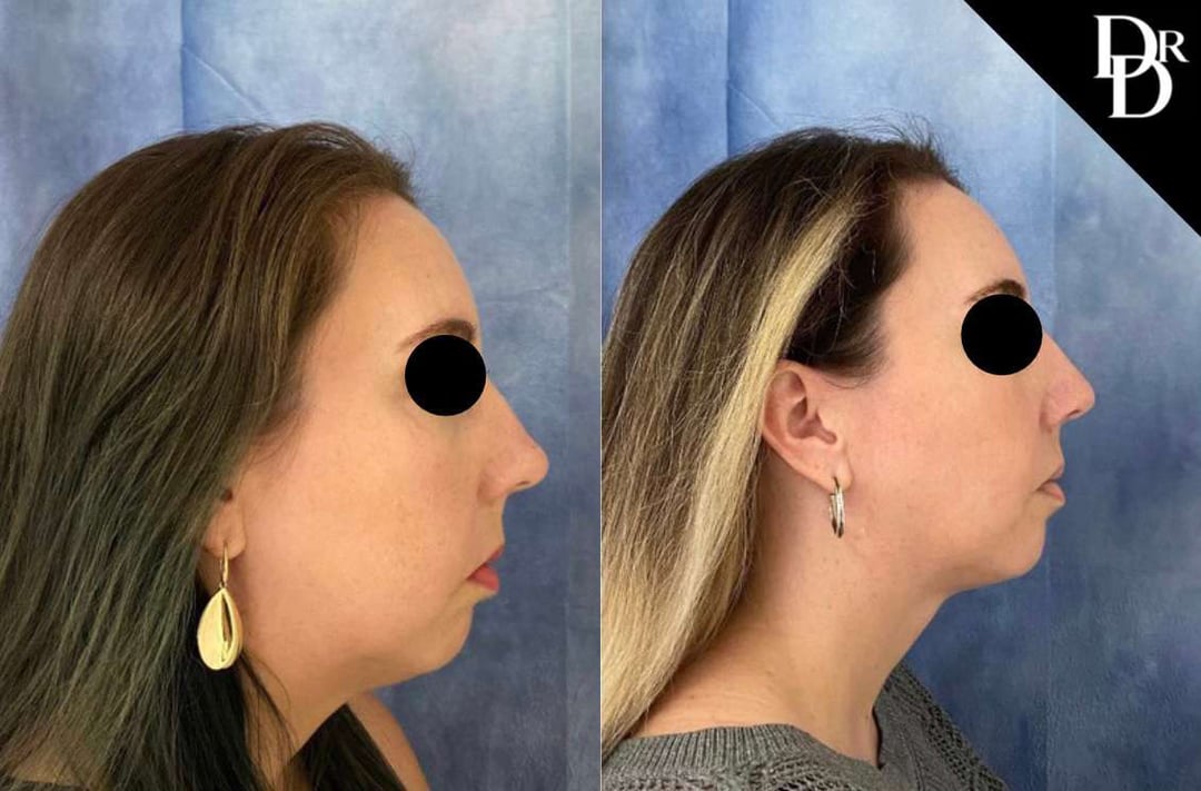Morpheus8 Before And After Photos By Dr. Demetri Arnaoutakis In Tampa, Fl
