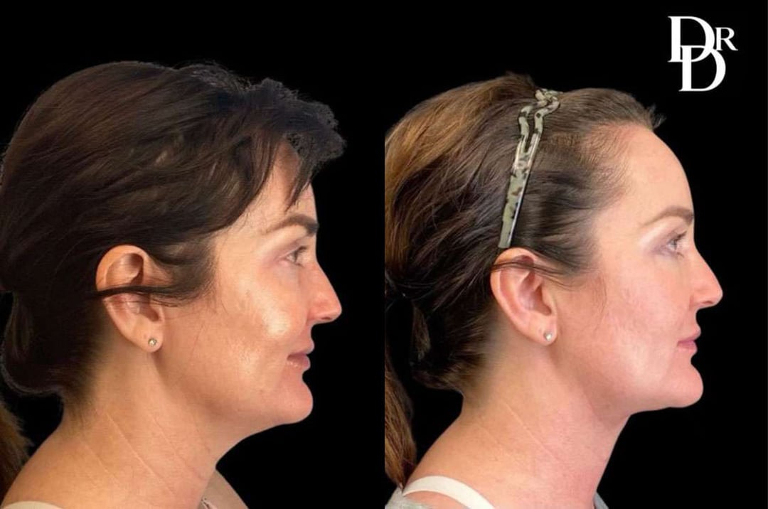 Facetite Before And After Photos By Dr. Demetri Arnaoutakis In Tampa, Fl
