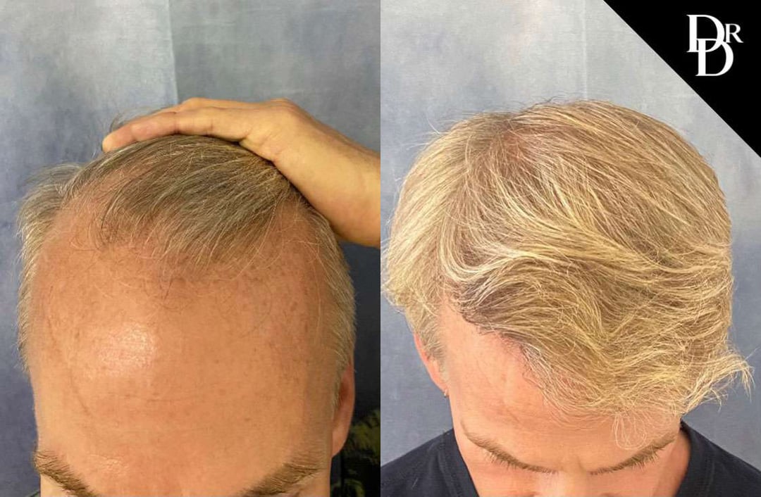 Hair Transplant Before And After Photos By Dr. Demetri Arnaoutakis In Tampa, Fl
