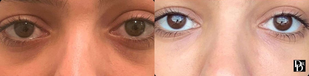 Injectable/Dermal Fillers Before And After Photos By Dr. Demetri Arnaoutakis In Tampa, Fl
