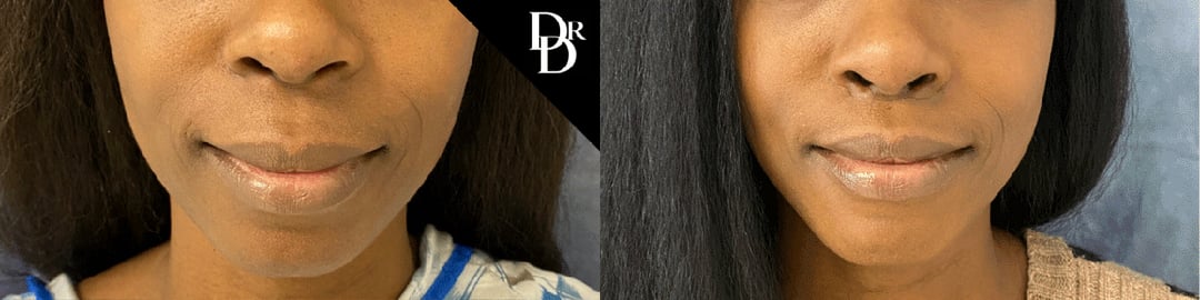 Lip Lift Before And After Photos By Dr. Demetri Arnaoutakis In Tampa, Fl