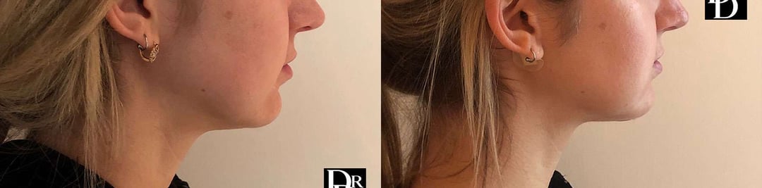 Neck Lift Before And After Photos By Dr. Demetri Arnaoutakis In Tampa, Fl
