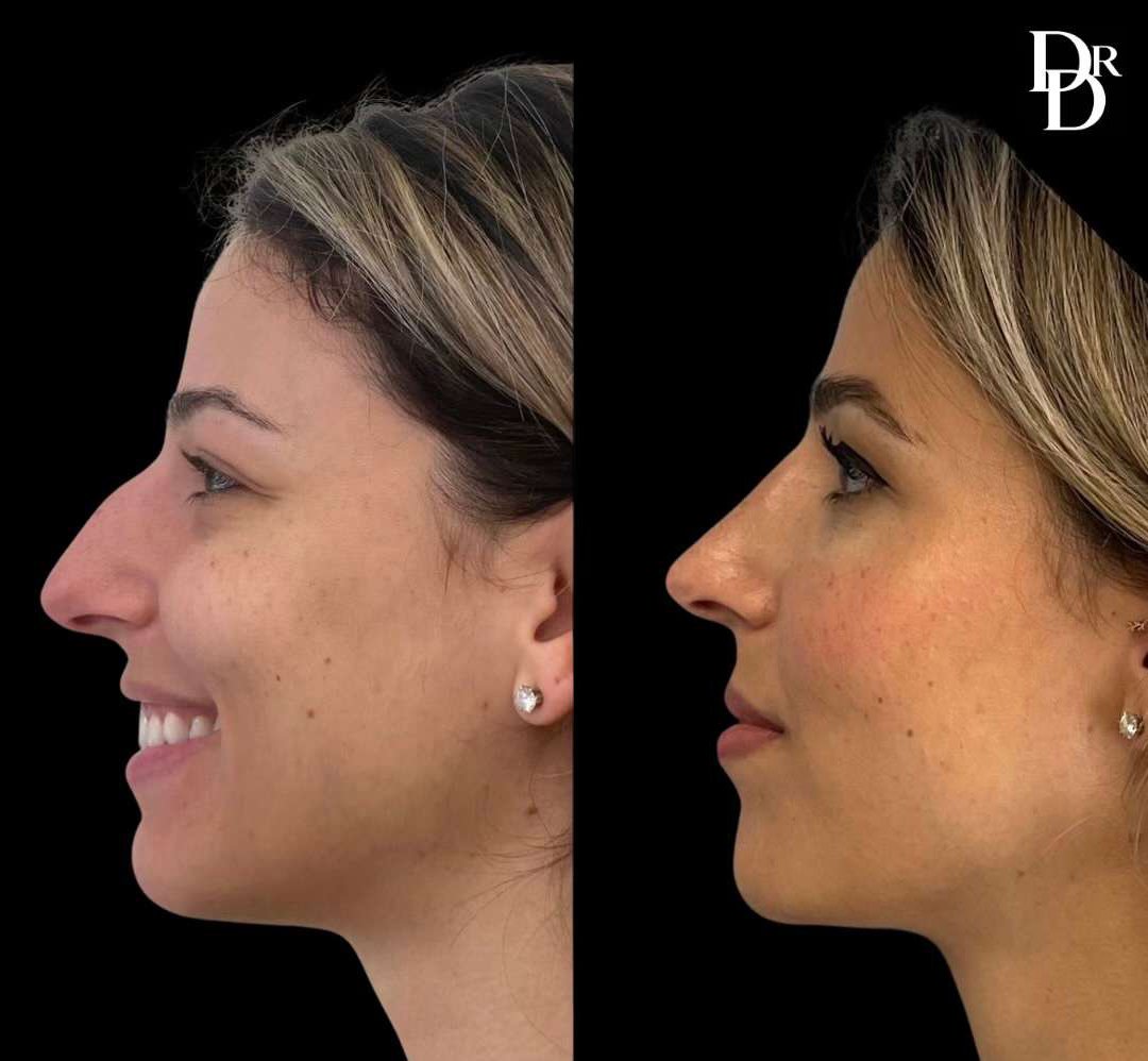 Rhinoplasty Before And After Photos By Dr. Demetri Arnaoutakis In Tampa, Fl