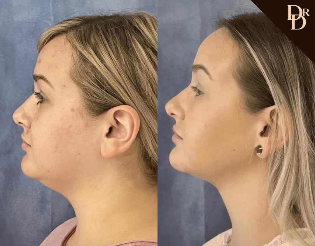Facetite Before And After Photos By Dr. Demetri Arnaoutakis In Tampa, Fl