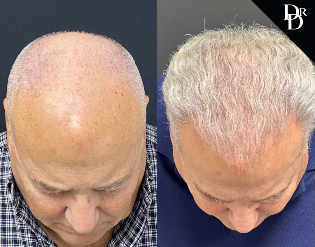 Hair Transplant Before And After Photos By Dr. Demetri Arnaoutakis In Tampa, Fl