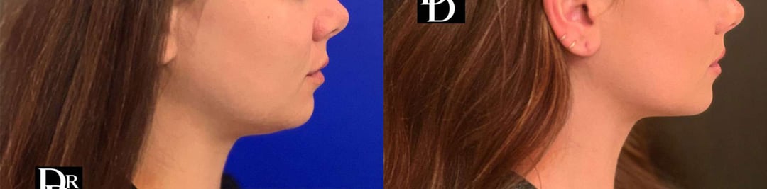 Neck Lift Before And After Photos By Dr. Demetri Arnaoutakis In Tampa, Fl