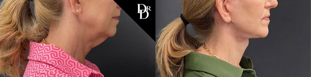Neck Lift Before And After Photos By Dr. Demetri Arnaoutakis In Tampa, Fl