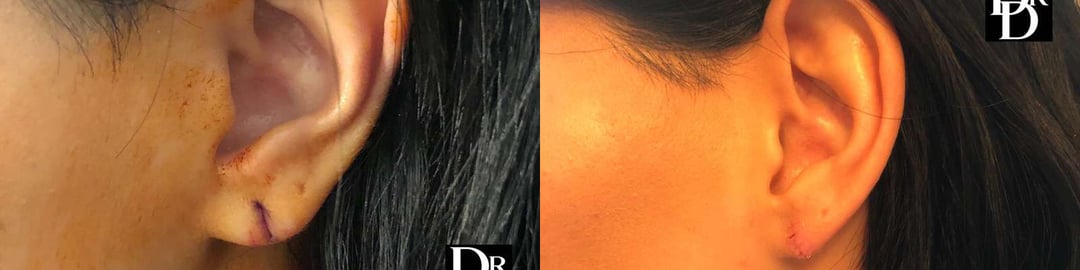 Earlobe Repair Before And After Photos By Dr. Demetri Arnaoutakis In Tampa, Fl