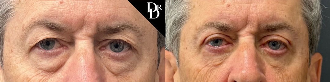 Eyelid Surgery Before And After Photos By Dr. Demetri Arnaoutakis In Tampa, Fl